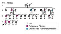 Adult-onset pulmonary fibrosis caused by mutations in telomerase